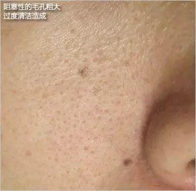 停止伤害你们的毛孔！毛孔粗大其实还有救!